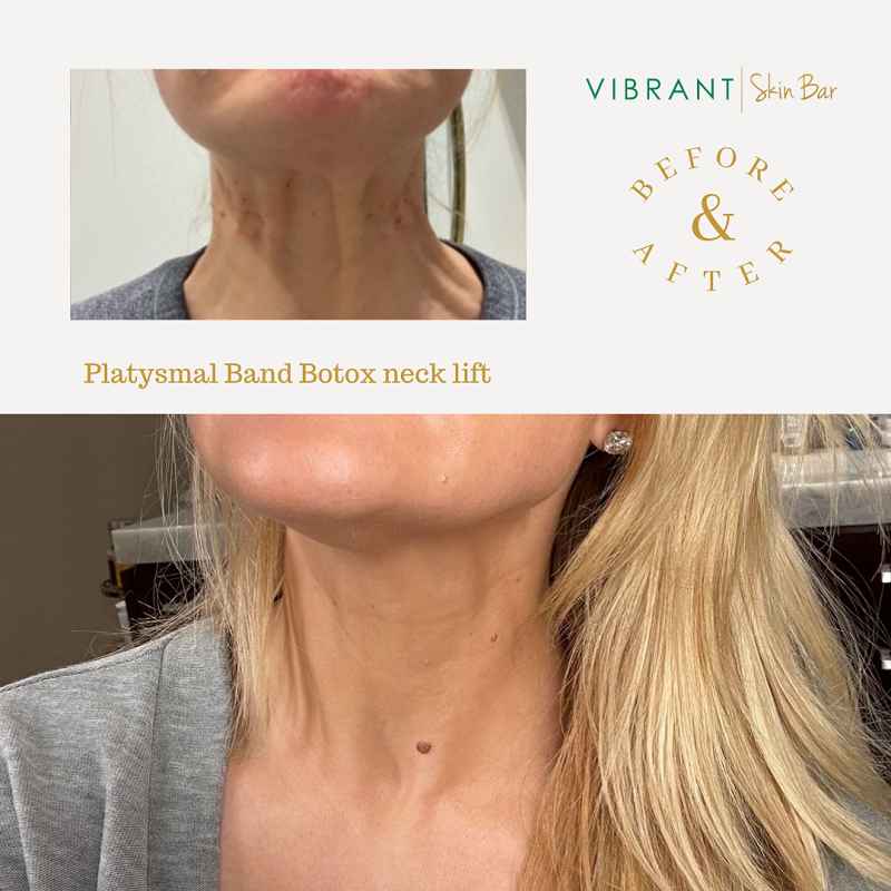 Neck Botox before and after