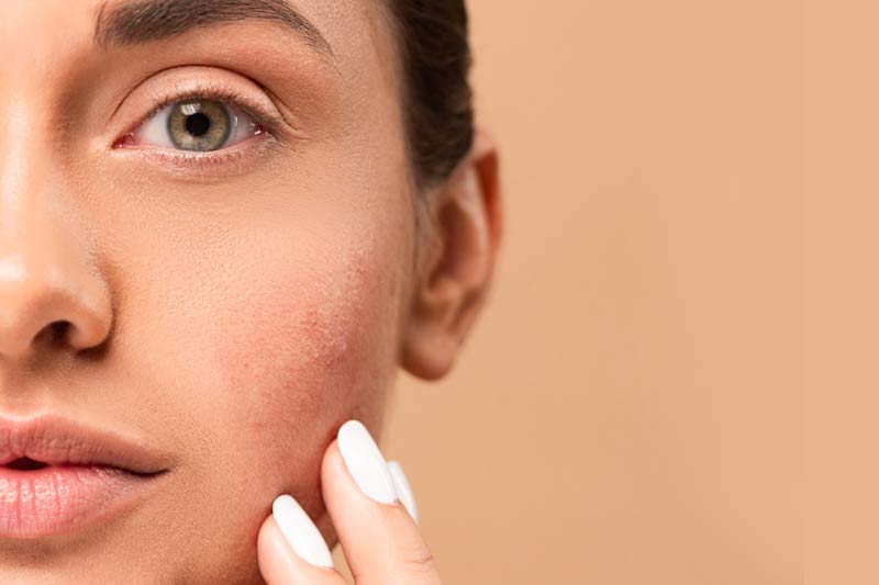 Niacinamide helps to reduce acne