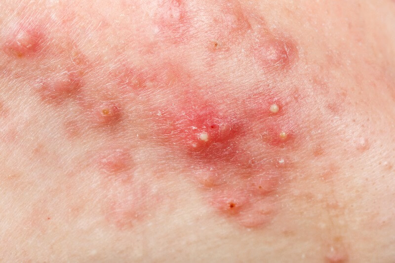 Nodules are painful, inflamed type of acne under the skin.