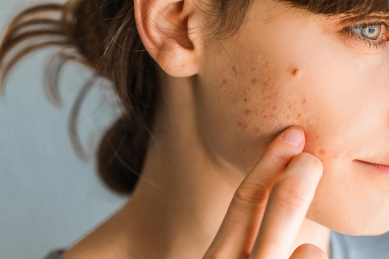 Acne reduction as an Omega-3 benefit for the skin