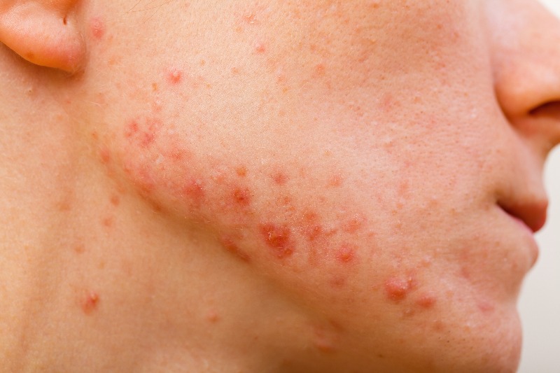 Papules are inflammatory, swollen bumps on the skin.