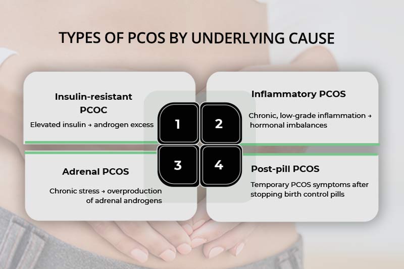 PCOS types by underlying cause