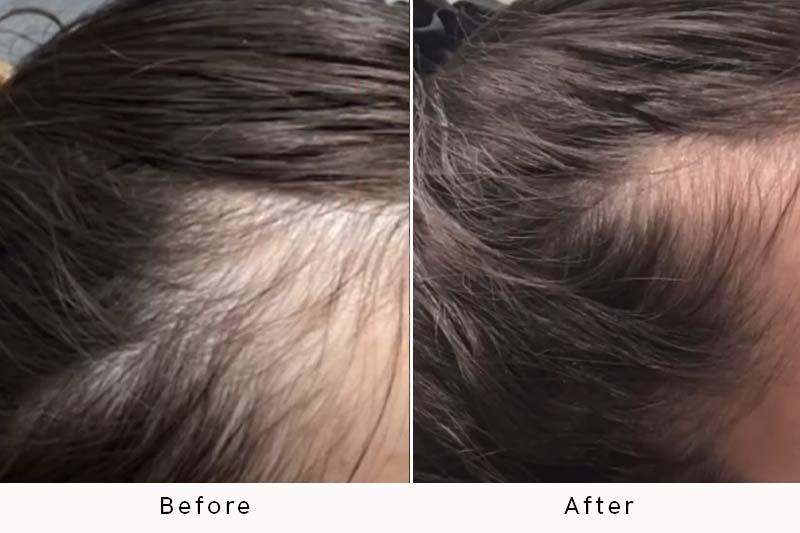 Before and after PRP hair treatment