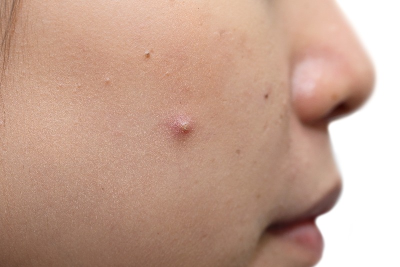 Pustules are inflammatory acne filled with pus.