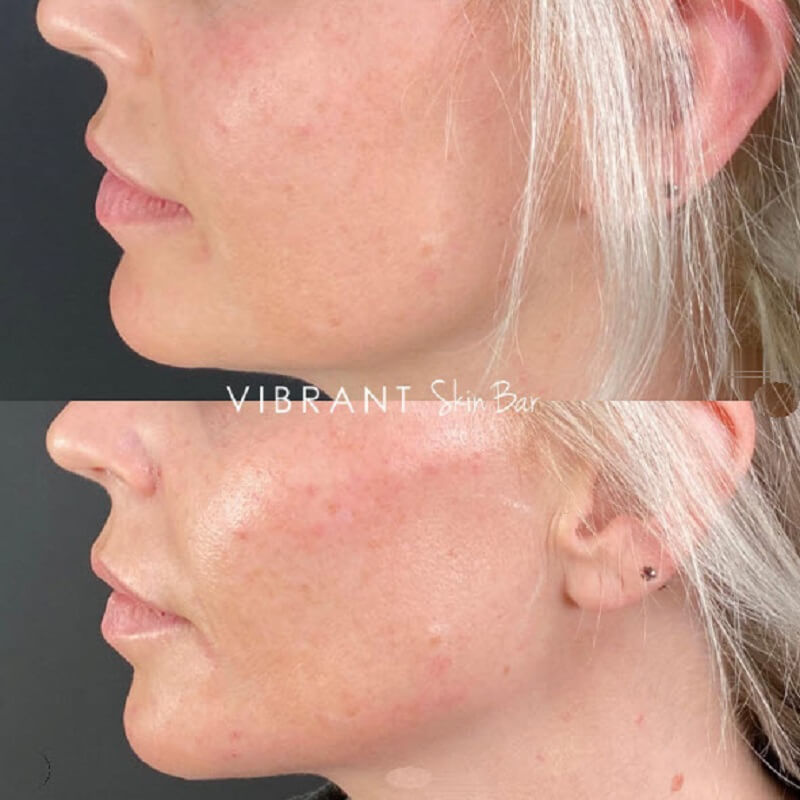 Before and after Restylane fillers