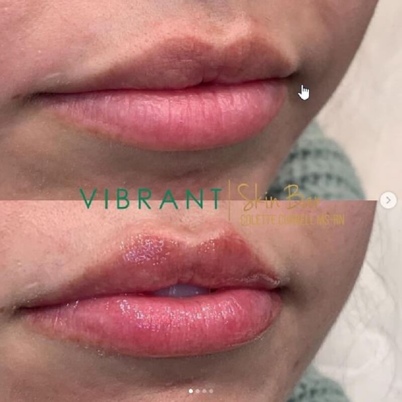 Before and after Restylane fillers