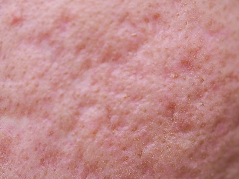 Rolling acne scars example