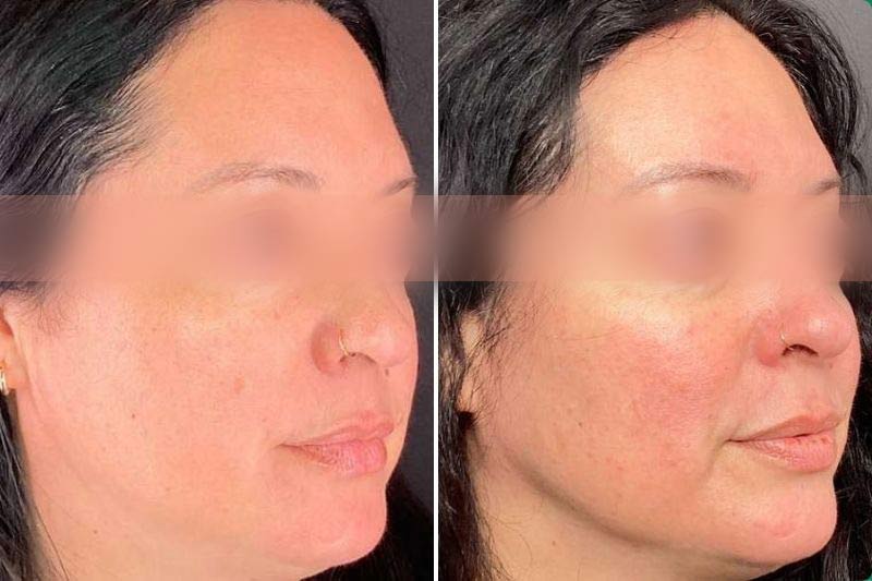 Before and after Sofwave