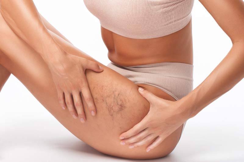 Spider veins and how to treat them