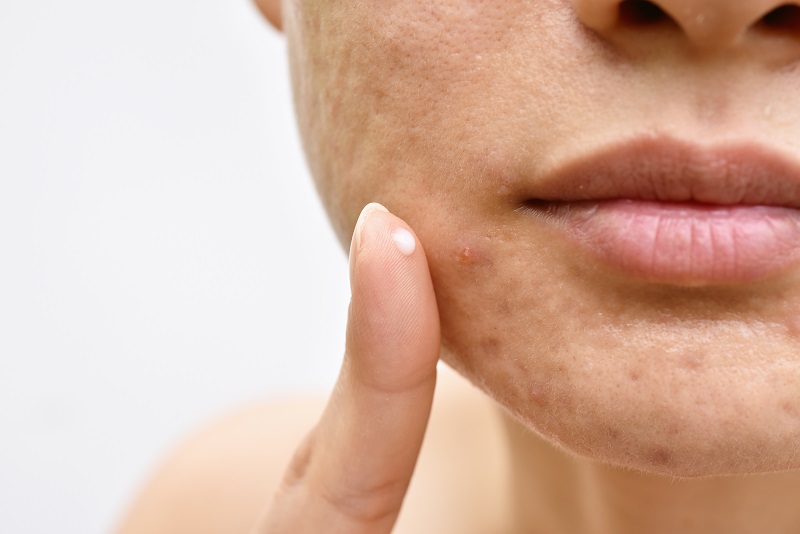 Some topicals may reduce acne scars.