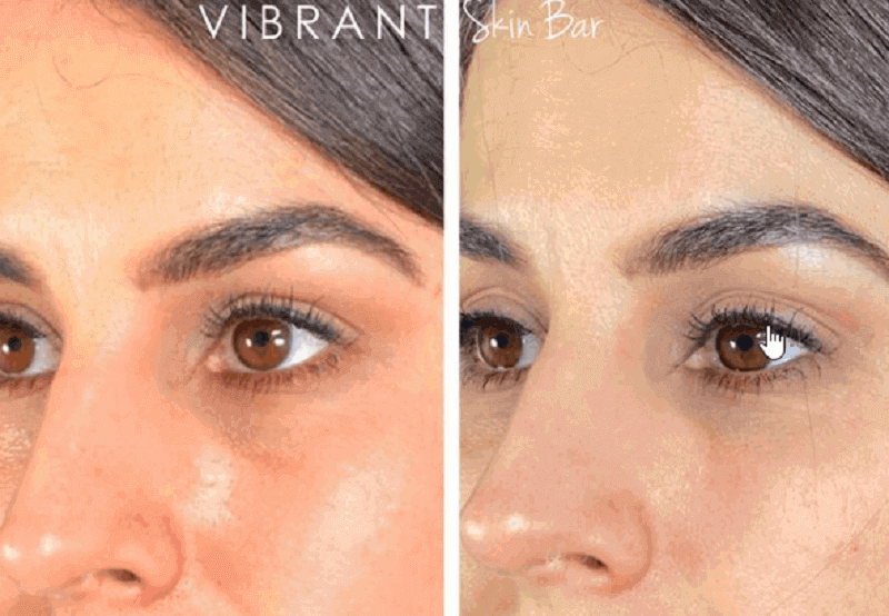 Under eye filler results - before and after treatment.