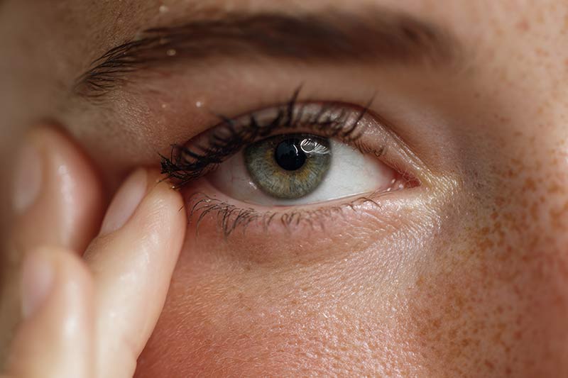 Microneedling under-eye results.