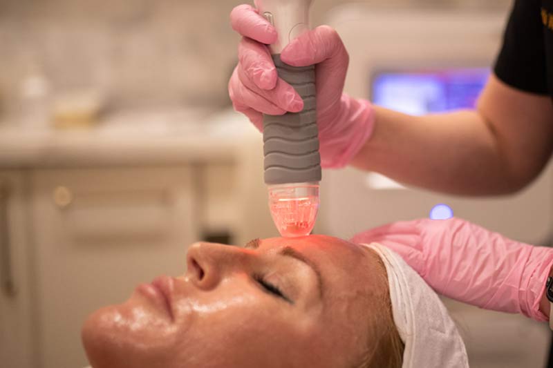 What can you expect during Vivace microneedling treatment