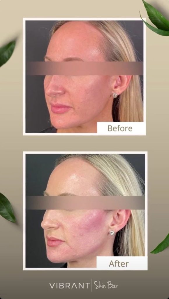 Before and after Juvederm jawline filler.