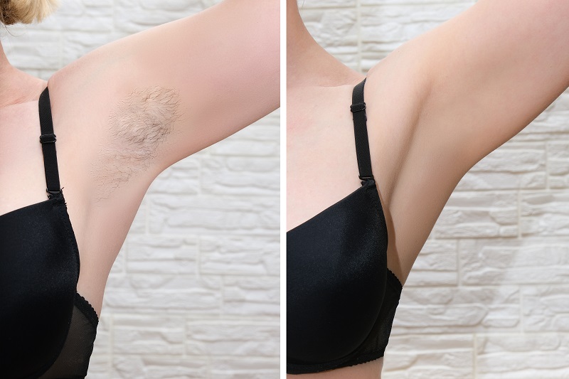 Waxing hair removal before and after