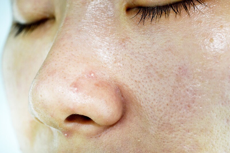 Whiteheads are non-inflammatory acne beneath the skin.